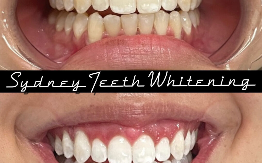 White Spots on Teeth after Teeth Whitening